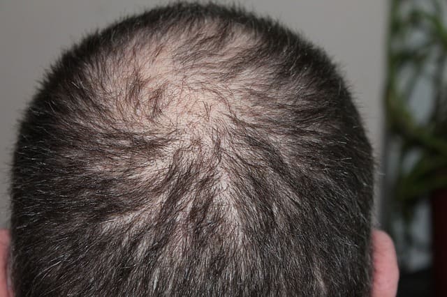 Is creating causing hair loss and baldness?